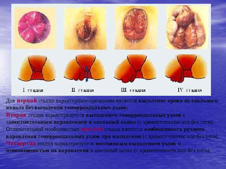 Для первой стадии характерным признаком является выделение крови из анального канала без выпадения геморроидальных