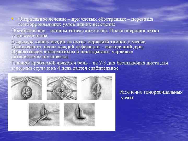  • Оперативное лечение – при частых обострениях – перевязка гемморроидальных узлов или их