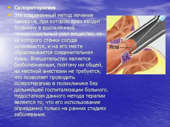  • Склеротерапия • Это современный метод лечения геморроя, при котором врач вводит больному