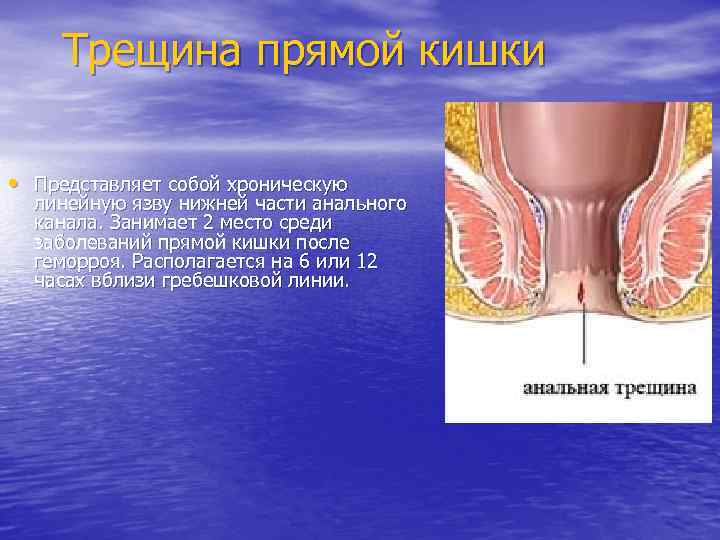 Трещина прямой кишки • Представляет собой хроническую линейную язву нижней части анального канала. Занимает