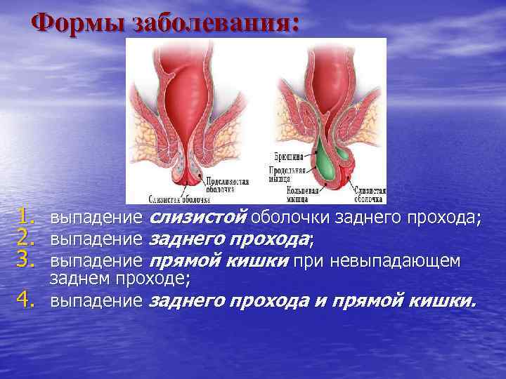 Формы заболевания: 1. выпадение слизистой оболочки заднего прохода; 2. выпадение заднего прохода; 3. выпадение