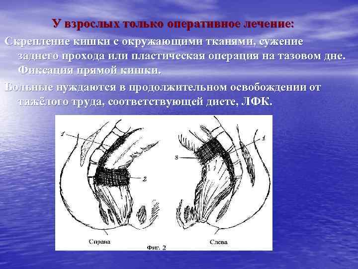 У взрослых только оперативное лечение: Скрепление кишки с окружающими тканями, сужение заднего прохода или