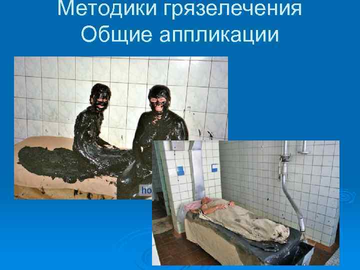 Методики грязелечения Общие аппликации 