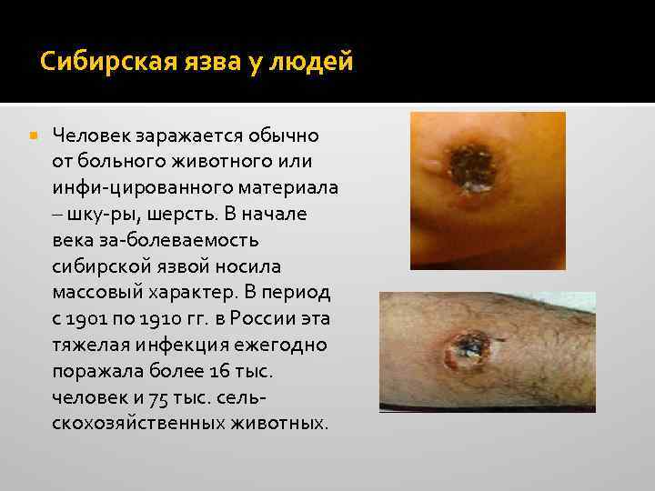 Сибирская язва у людей Человек заражается обычно от больного животного или инфи-цированного материала –