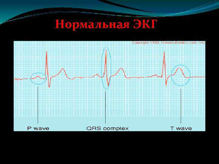Нормальная ЭКГ 