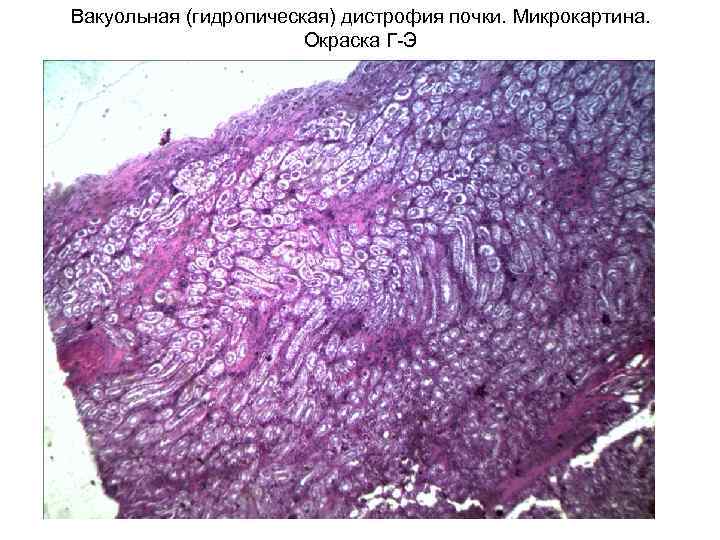 Вакуольная (гидропическая) дистрофия почки. Микрокартина. Окраска Г-Э 