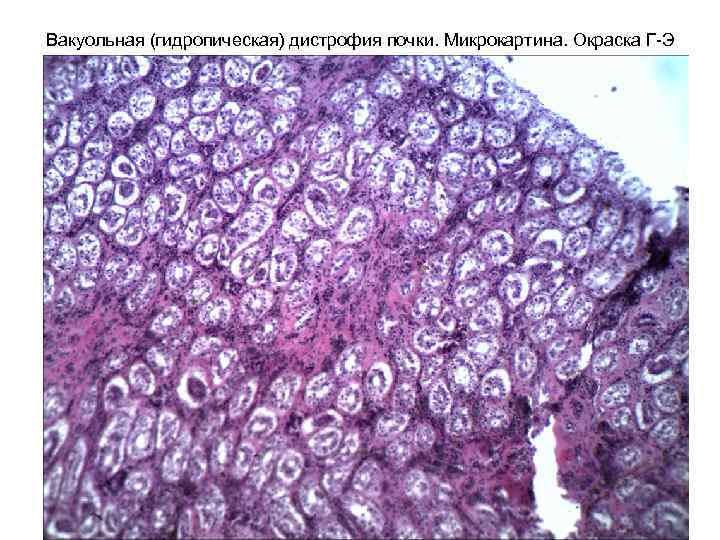 Вакуольная (гидропическая) дистрофия почки. Микрокартина. Окраска Г-Э 