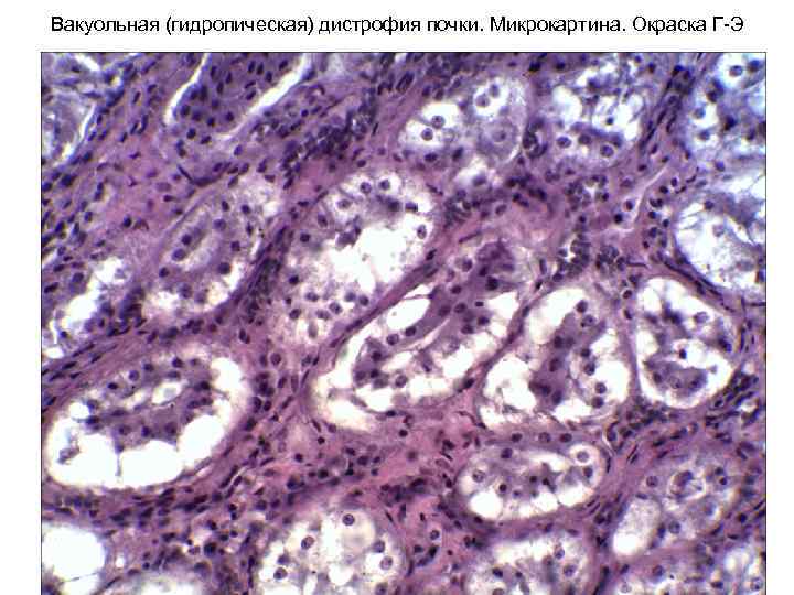 Вакуольная (гидропическая) дистрофия почки. Микрокартина. Окраска Г-Э 