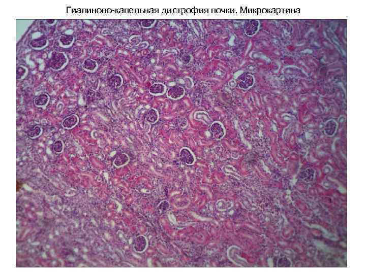 Зернистая дистрофия микроскопическая картина