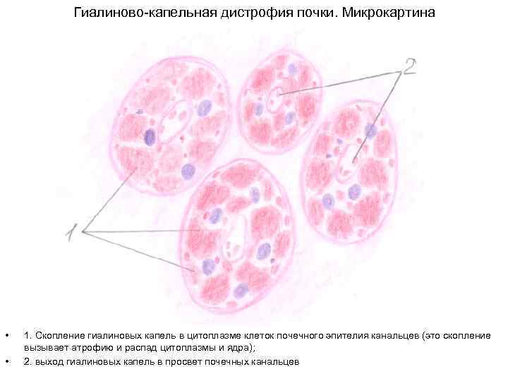 Зернистая дистрофия микроскопическая картина