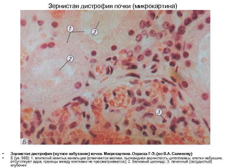 Зернистая дистрофия почки (микрокартина) • • Зернистая дистрофия (мутное набухание) почки. Микрокартина. Окраска Г-Э.