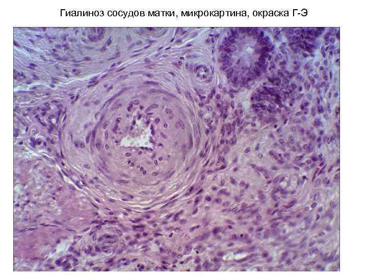 Гиалиноз сосудов матки, микрокартина, окраска Г-Э 