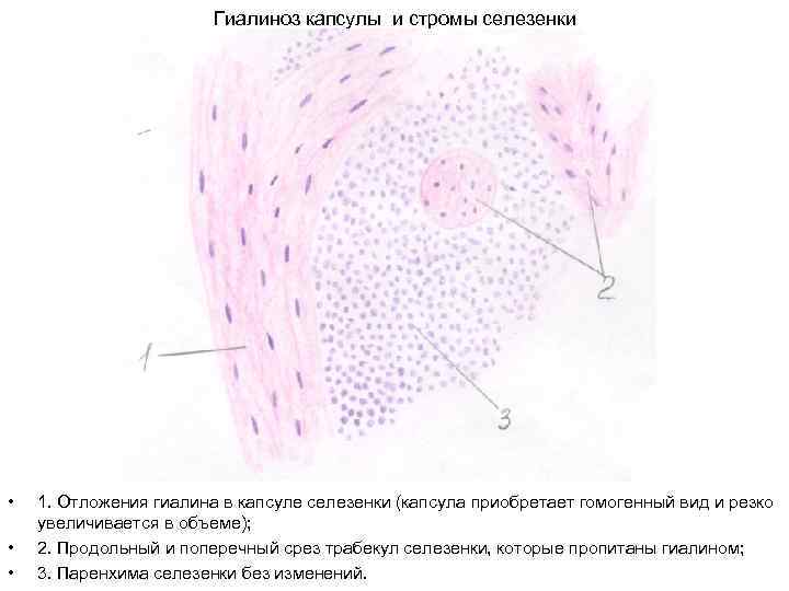 Гиалиноз капсулы и стромы селезенки • • • 1. Отложения гиалина в капсуле селезенки