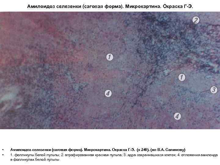 Амилоидоз селезенки (саговая форма). Микрокартина. Окраска Г-Э. • • Амилоидоз селезенки (саговая форма). Микрокартина.