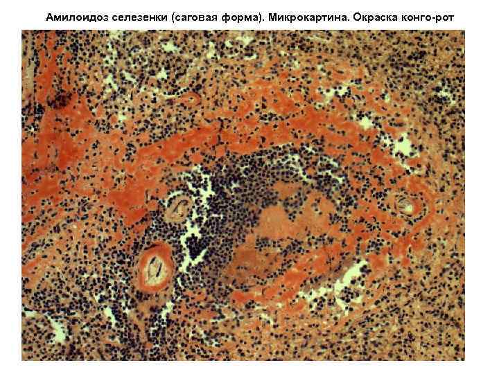 Амилоидоз селезенки (саговая форма). Микрокартина. Окраска конго-рот 