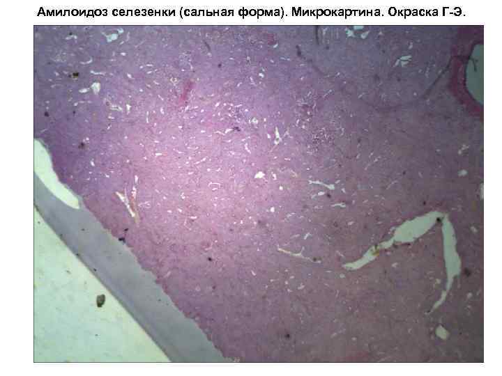 Амилоидоз селезенки (сальная форма). Микрокартина. Окраска Г-Э. 