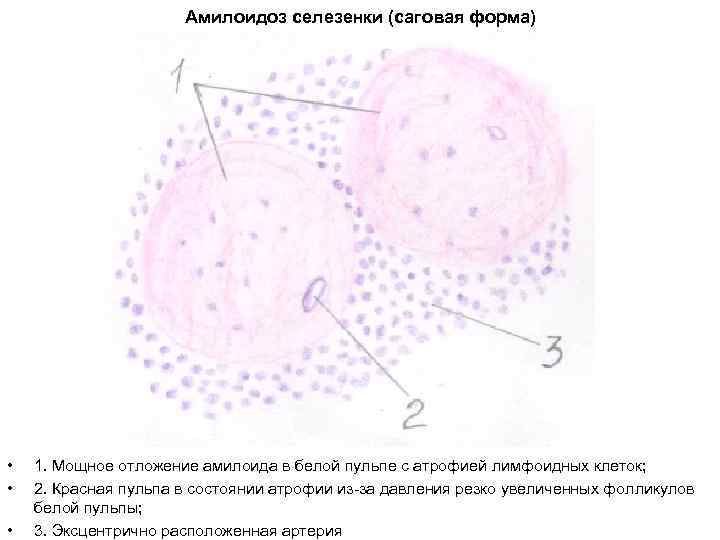 Амилоидоз селезенки (саговая форма) • • • 1. Мощное отложение амилоида в белой пульпе