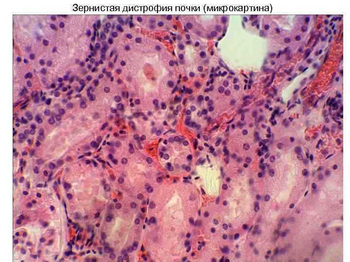 Зернистая дистрофия почки (микрокартина) 