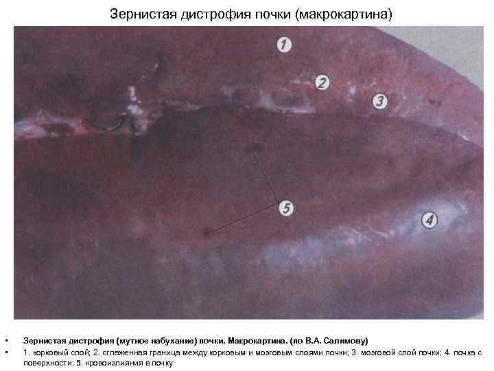 Зернистая дистрофия почки (макрокартина) • • Зернистая дистрофия (мутное набухание) почки. Макрокартина. (по В.