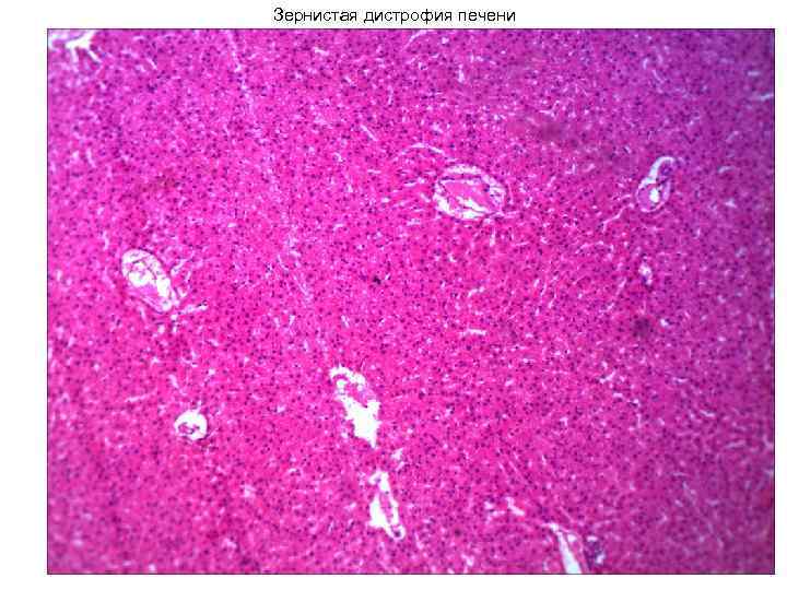 Зернистая дистрофия печени 