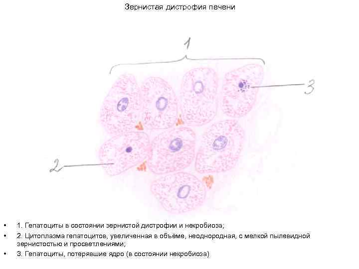 Зернистая дистрофия микроскопическая картина