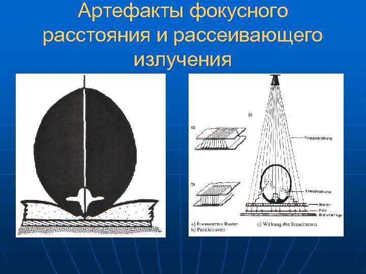 Артефакты фокусного расстояния и рассеивающего излучения 