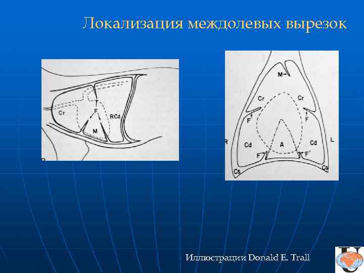 Локализация междолевых вырезок Иллюстрации Donald E. Trall 