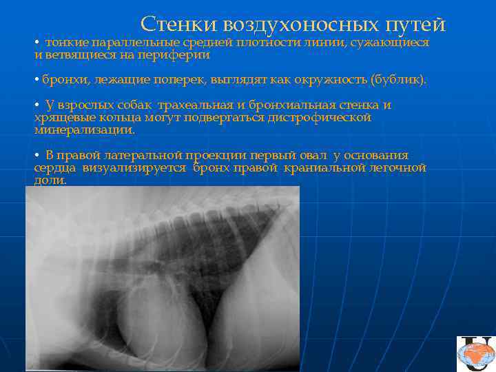 Стенки воздухоносных путей • тонкие параллельные средней плотности линии, сужающиеся и ветвящиеся на периферии