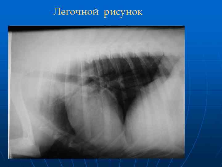 Легочной рисунок 