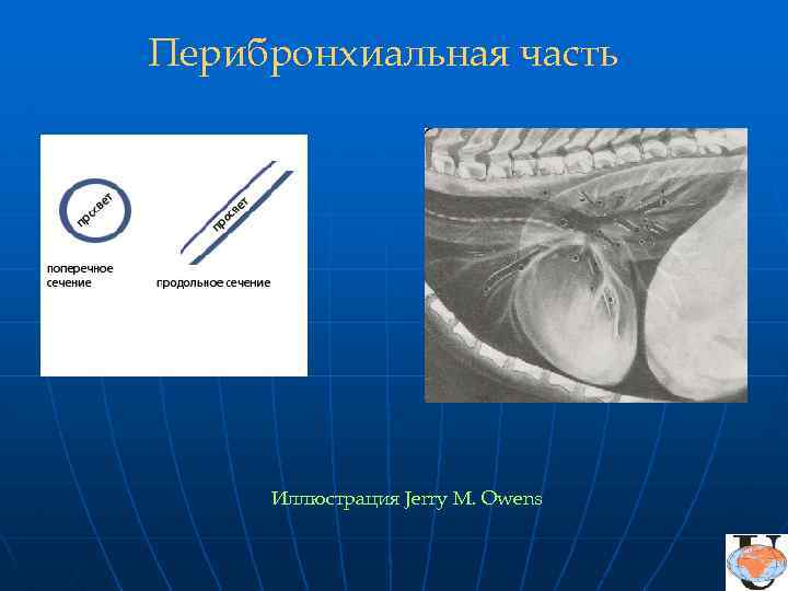 Перибронхиальная часть Иллюстрация Jerry M. Owens 