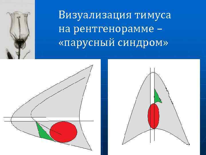 Визуализация тимуса на рентгенорамме – «парусный синдром» 