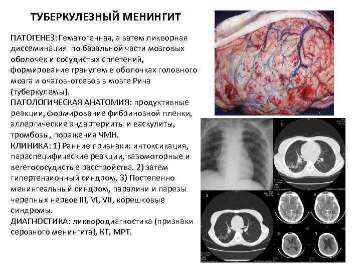 ТУБЕРКУЛЕЗНЫЙ МЕНИНГИТ ПАТОГЕНЕЗ: Гематогенная, а затем ликворная диссеминация по базальной части мозговых оболочек и