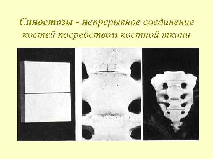 Синостозы - непрерывное соединение костей посредством костной ткани 