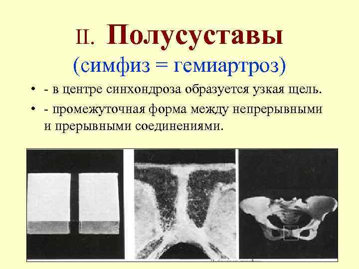 II. Полусуставы (симфиз = гемиартроз) • - в центре синхондроза образуется узкая щель. •