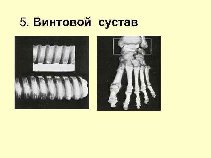 5. Винтовой сустав 