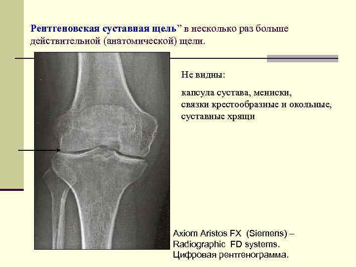 Рентгеновская суставная щель” в несколько раз больше действительной (анатомической) щели. Не видны: капсула сустава,