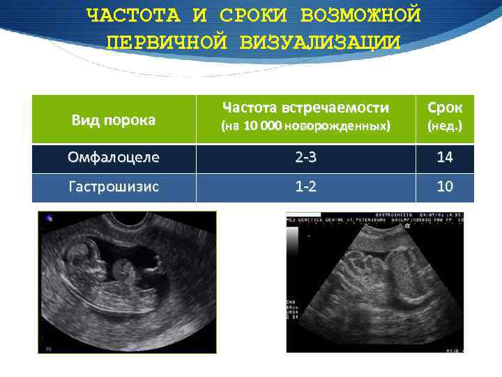 ЧАСТОТА И СРОКИ ВОЗМОЖНОЙ ПЕРВИЧНОЙ ВИЗУАЛИЗАЦИИ Частота встречаемости Срок Вид порока (на 10 000