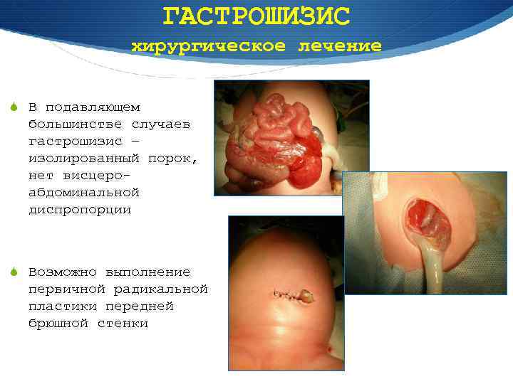 ГАСТРОШИЗИС хирургическое лечение S В подавляющем большинстве случаев гастрошизис – изолированный порок, нет висцероабдоминальной