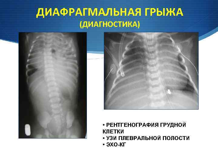 Грыжа диафрагмы. Рентгенография диафрагмальная грыжа. Врожденная диафрагмальная грыжа рентген. Изолированная врожденная диафрагмальная грыжа. Диафрагмальная грыжа на рентгене грудной клетки.