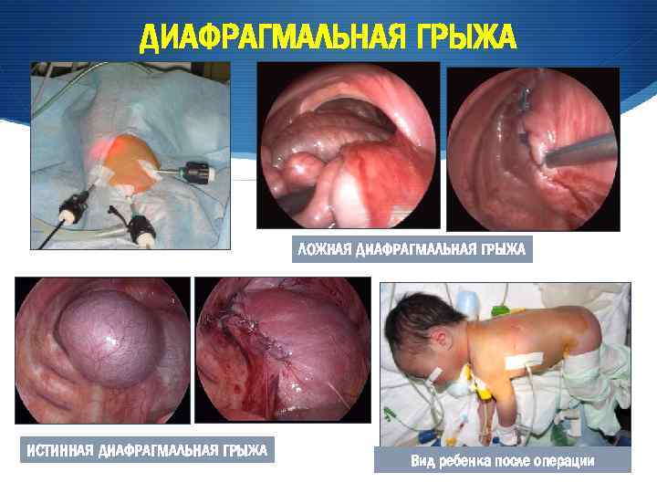 ДИАФРАГМАЛЬНАЯ ГРЫЖА ПЛАСТИКА КУПОЛА ДИАФРАГМЫ ЛОЖНАЯ ДИАФРАГМАЛЬНАЯ ГРЫЖА ИСТИННАЯ ДИАФРАГМАЛЬНАЯ ГРЫЖА Вид ребенка после