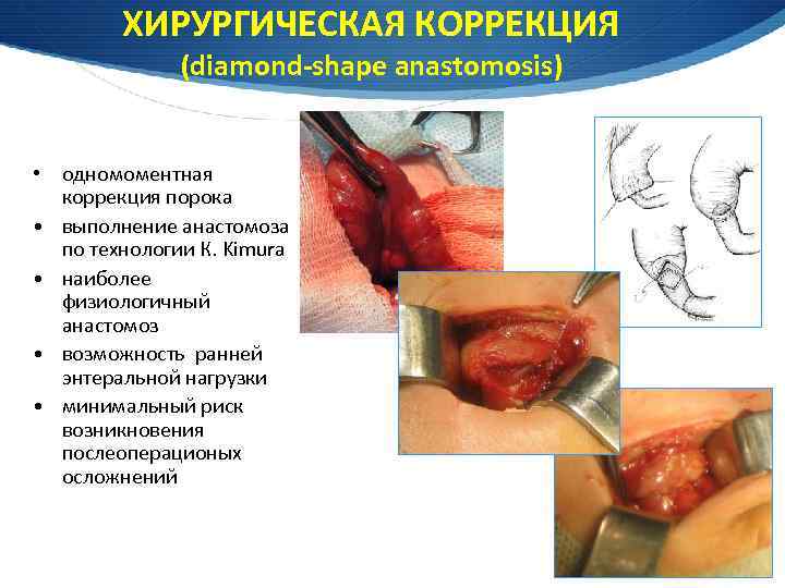 ХИРУРГИЧЕСКАЯ КОРРЕКЦИЯ (diamond-shape anastomosis) • одномоментная коррекция порока • выполнение анастомоза по технологии К.