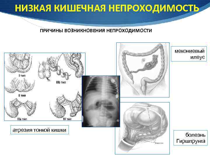 Врожденная кишечная. Мекониевая непроходимость кишечника. Врожденная низкая кишечная непроходимость. Низкая толстокишечная непроходимость. Мекониальная кишечная непроходимость.