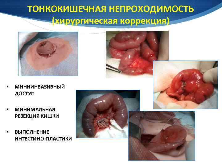 ТОНКОКИШЕЧНАЯ НЕПРОХОДИМОСТЬ (хирургическая коррекция) • МИНИИНВАЗИВНЫЙ ДОСТУП • МИНИМАЛЬНАЯ РЕЗЕКЦИЯ КИШКИ • ВЫПОЛНЕНИЕ ИНТЕСТИНО-ПЛАСТИКИ