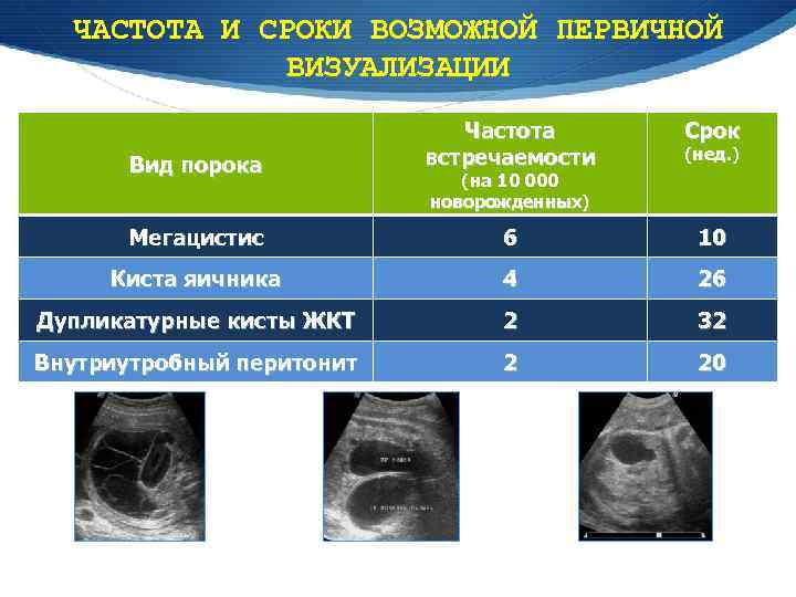 ЧАСТОТА И СРОКИ ВОЗМОЖНОЙ ПЕРВИЧНОЙ ВИЗУАЛИЗАЦИИ Срок Вид порока Частота встречаемости Мегацистис 6 10