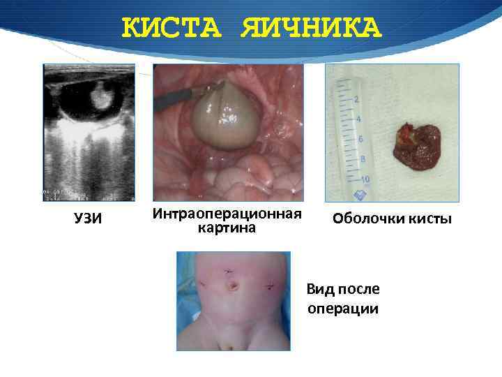 Нет стула после лапароскопии кисты яичника