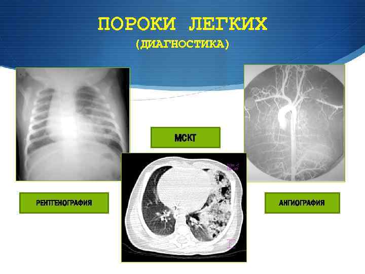 Пороки развития легких презентация