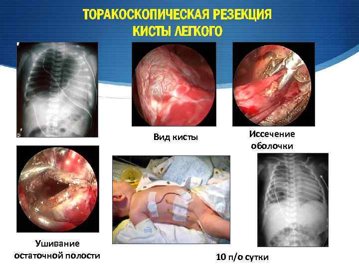 ТОРАКОСКОПИЧЕСКАЯ РЕЗЕКЦИЯ КИСТЫ ЛЕГКОГО Вид кисты Ушивание остаточной полости Иссечение оболочки 10 п/о сутки
