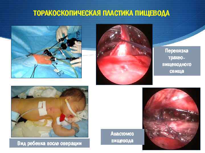 ТОРАКОСКОПИЧЕСКАЯ ПЛАСТИКА ПИЩЕВОДА Перевязка трахеопищеводного свища Вид ребенка после операции Анастомоз пищевода 