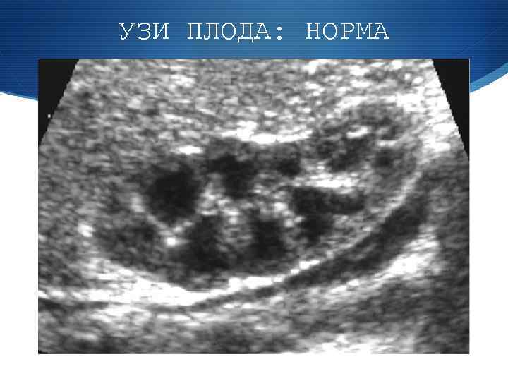 УЗИ ПЛОДА: НОРМА 
