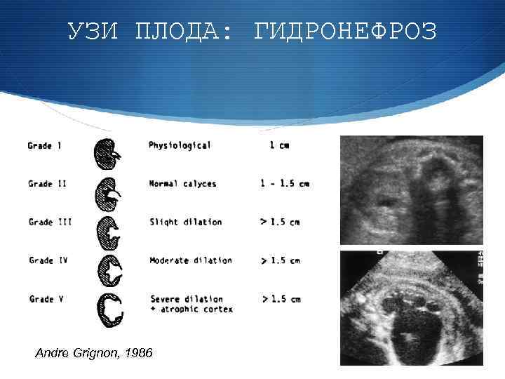 УЗИ ПЛОДА: ГИДРОНЕФРОЗ Andre Grignon, 1986 